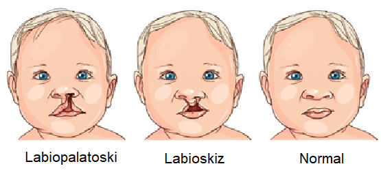 ANAK DENGAN BIBIR SUMBING? TETAPLAH BERSYUKUR YA UKHTI…